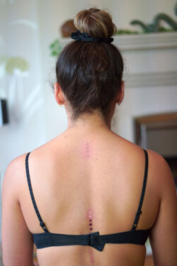 See the skin burns on this lady's back. These burns are often called gates and are where the frog secretion is placed.