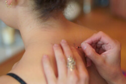 Making Kambo Burns on Skin